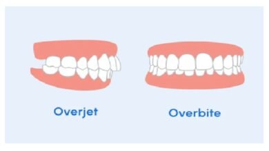 Overbite, Underbite